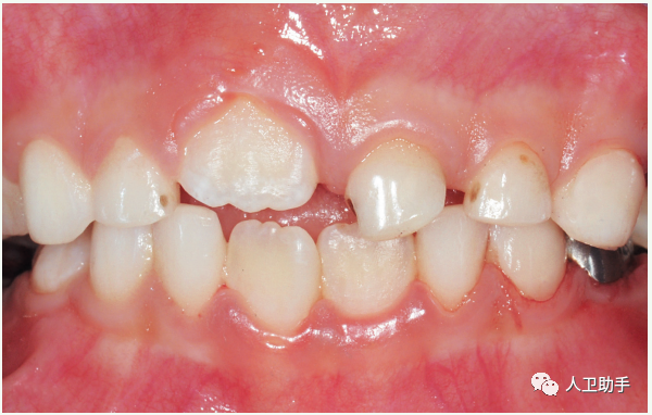 儿童换牙需要补钙吗(补钙儿童换牙需要多久)-硒宝网