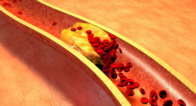 血脂高的人怎样补硒（补硒可以降血脂吗）-硒宝网