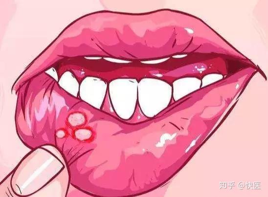 补硒治疗口腔溃疡吗(硒对口腔溃疡有没有好处)-硒宝网