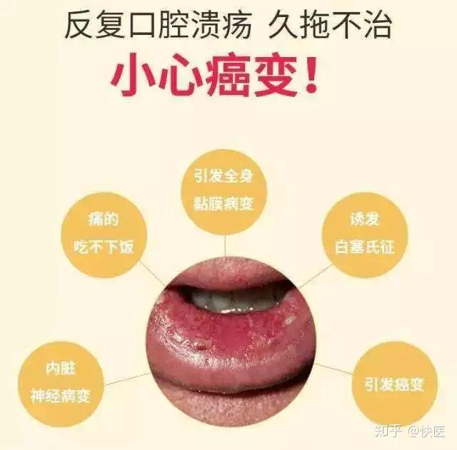 补硒治疗口腔溃疡吗(硒对口腔溃疡有没有好处)-硒宝网