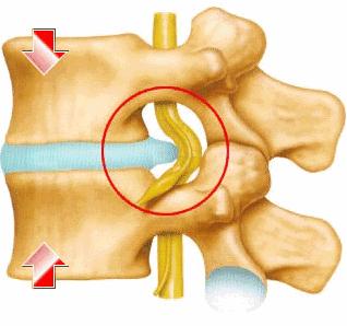 腰椎间盘突出要补钙吗(腰椎间盘突出要多补钙吗)-硒宝网