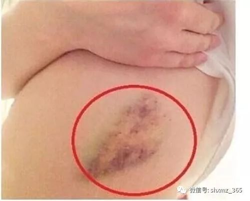 补硒有能预防肝癌吗（硒对肝癌的作用）-硒宝网