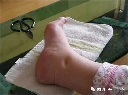 补硒有能预防肝癌吗（硒对肝癌的作用）-硒宝网