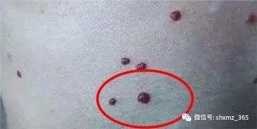 补硒有能预防肝癌吗（硒对肝癌的作用）-硒宝网