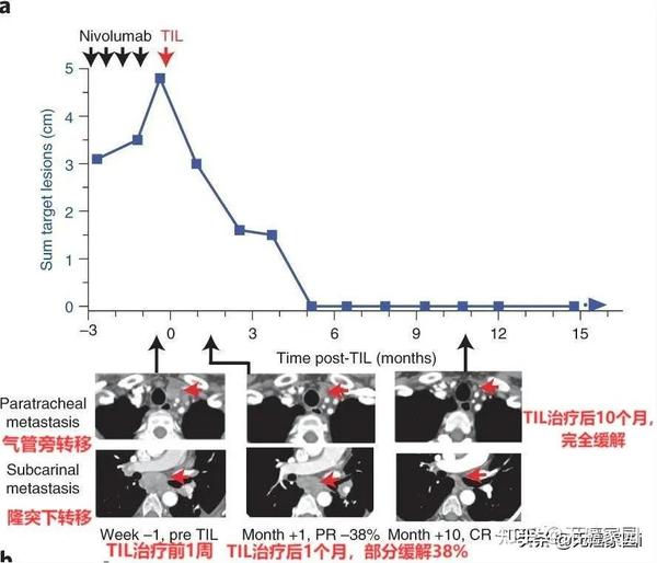 肺腺癌肋骨转移补硒(肺转移补肋骨硒腺癌能治愈吗)-硒宝网
