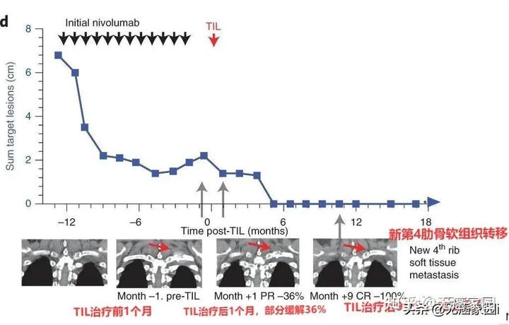 肺腺癌肋骨转移补硒(肺转移补肋骨硒腺癌能治愈吗)-硒宝网