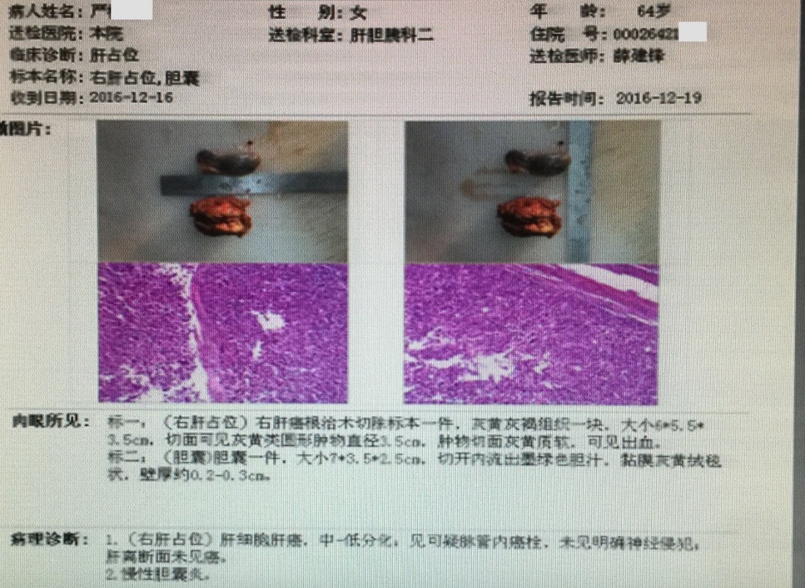 肝癌病人可以补硒吗(肝癌能补硒吗)-硒宝网