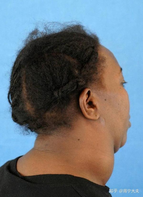 甲状腺素高能补硒吗(甲状腺能补硒吗)-硒宝网