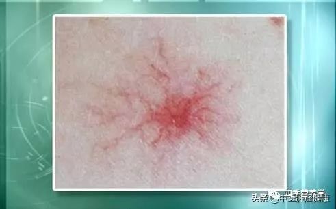 补硒有利于静脉扩张（扩张静脉的药）-硒宝网