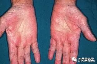 补硒有利于静脉扩张（扩张静脉的药）-硒宝网