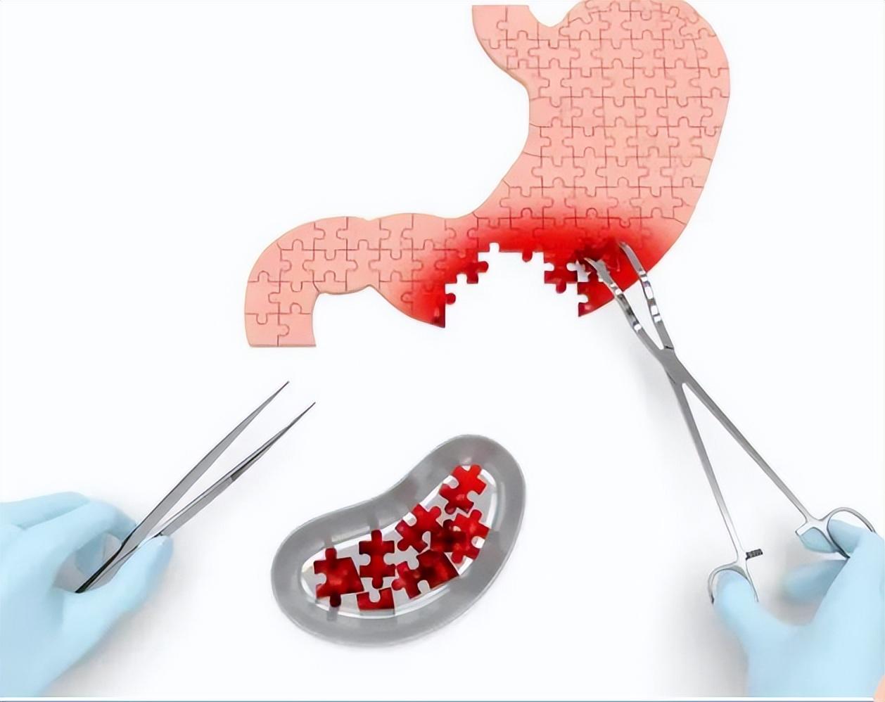 胃部手术后能补硒吗(胃部手术后能吃西洋参吗)-硒宝网