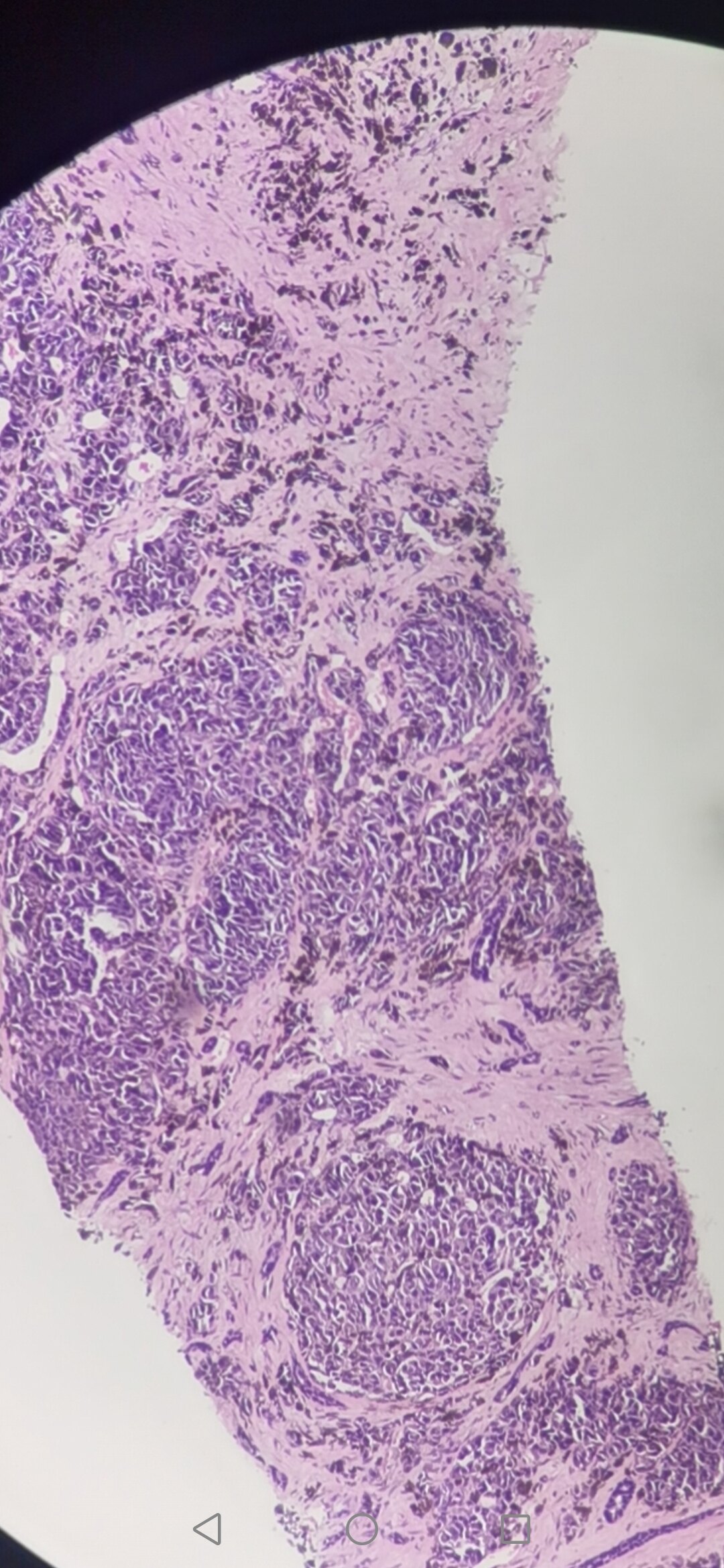 小细胞癌补硒有用不（补硒治疗癌症）-硒宝网