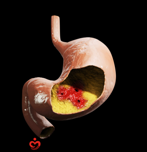 浅表性慢性胃炎补硒（慢性胃浅表性胃炎吃什么药）-硒宝网