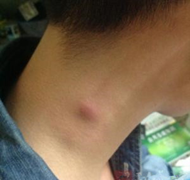 淋巴瘤患者可以补硒(淋巴癌可以吃硒吗)-硒宝网