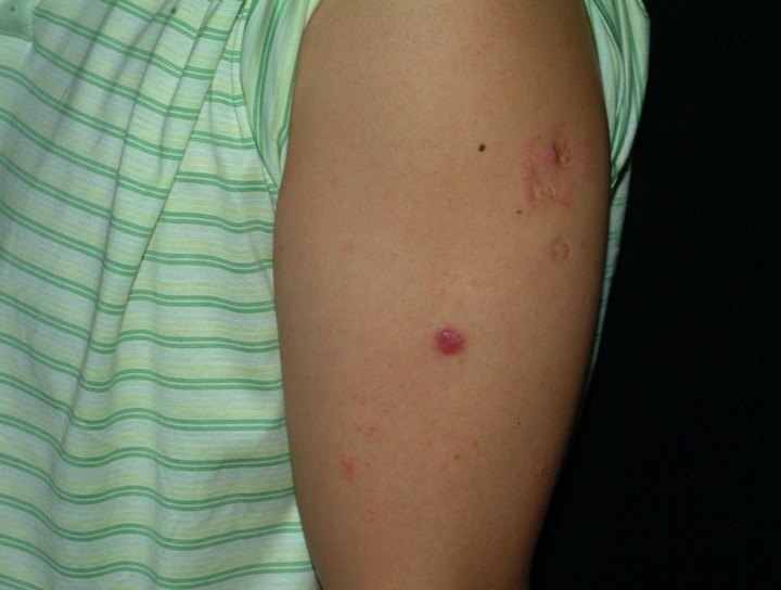 淋巴瘤患者可以补硒(淋巴癌可以吃硒吗)-硒宝网