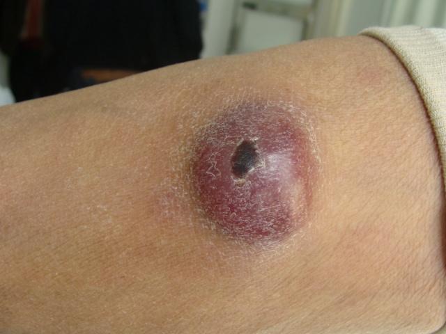 淋巴瘤患者可以补硒(淋巴癌可以吃硒吗)-硒宝网