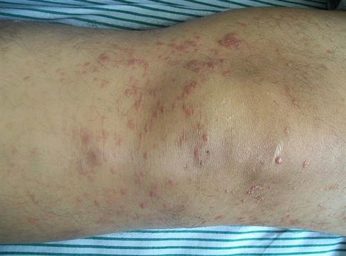 淋巴瘤患者可以补硒(淋巴癌可以吃硒吗)-硒宝网