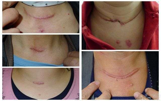 甲状腺术后补钙原则(术甲状腺原则补钙后会复发吗)-硒宝网