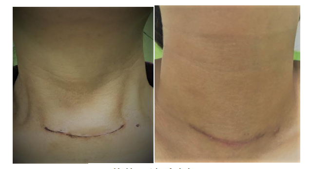 甲状腺术后补钙原则(术甲状腺原则补钙后会复发吗)-硒宝网