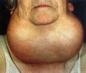 甲状腺术后补钙原则(术甲状腺原则补钙后注意什么)-硒宝网