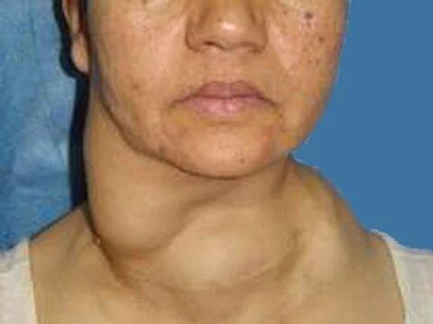 甲状腺术后补钙原则(术甲状腺原则补钙后注意什么)-硒宝网