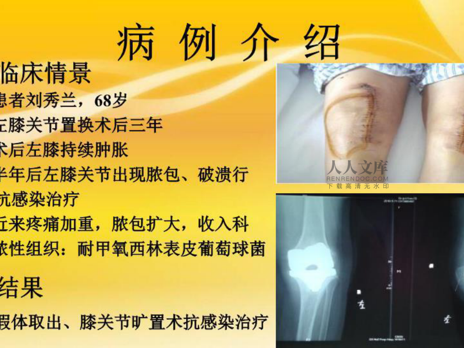 大骨节病补硒可以吗（硒和骨关节有什么关系）-硒宝网