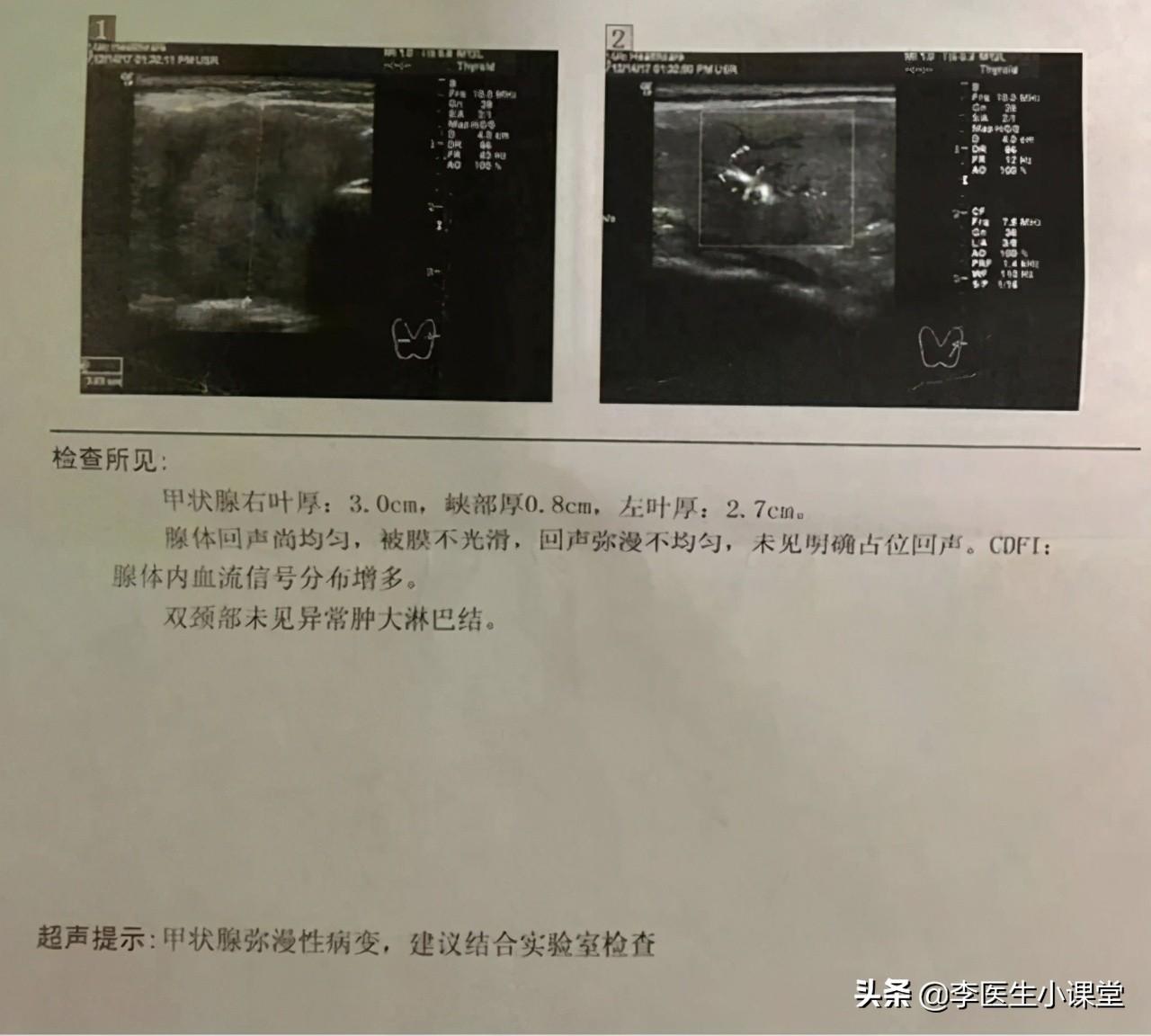 甲亢用补硒嘛有用吗(甲亢补硒能减少复发吗)-硒宝网