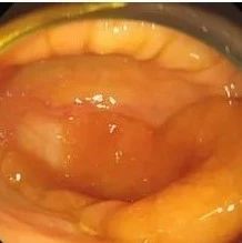 补硒对前列腺癌好吗（硒对前列腺癌的作用）-硒宝网