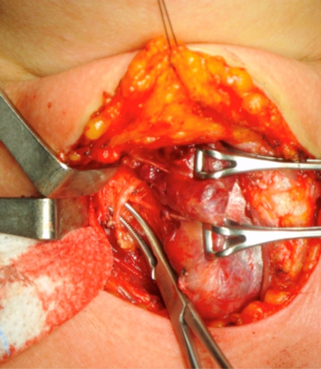 补硒对前列腺癌好吗（硒对前列腺癌的作用）-硒宝网