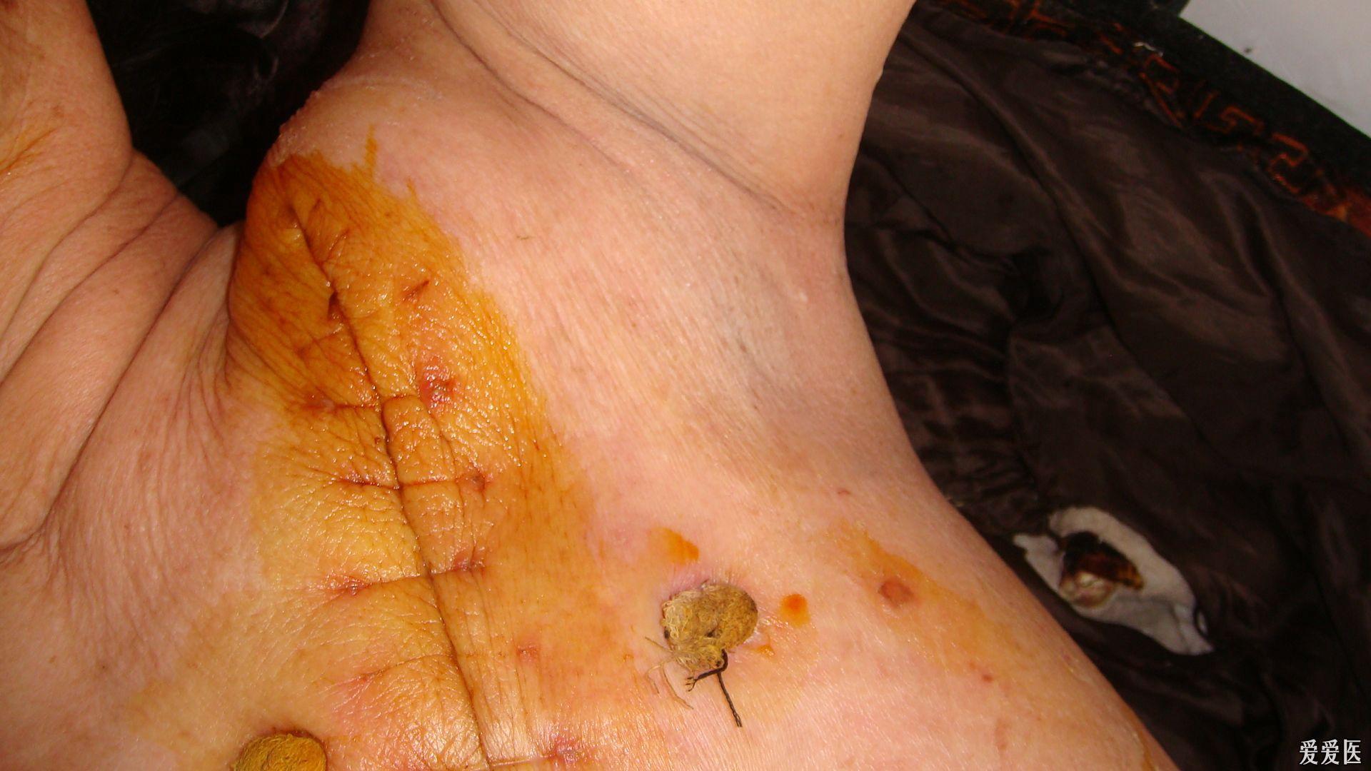 补硒对前列腺癌好吗（硒对前列腺癌的作用）-硒宝网