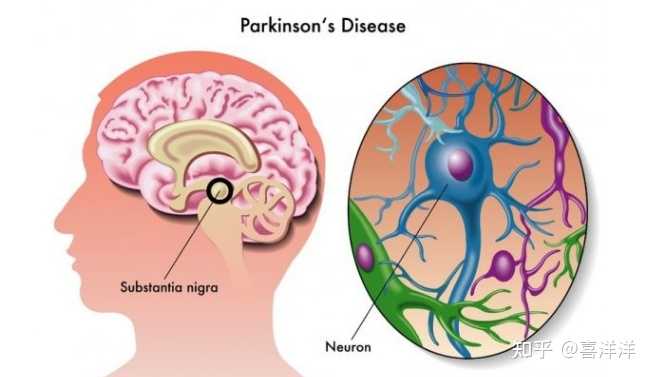 补硒能治帕金森病吗(硒对帕金森病病症有用吗)-硒宝网
