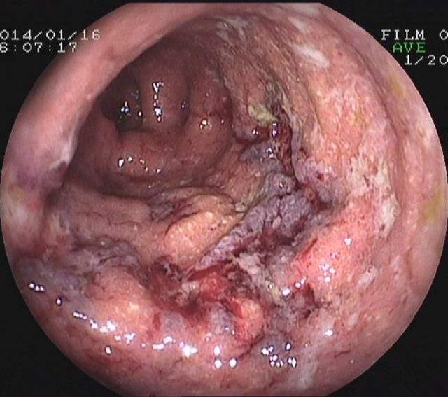 补硒可以预防三高吗(硒对三高好处)-硒宝网