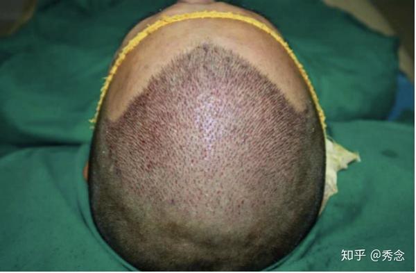 红斑狼疮能不能补硒（系统性红斑狼疮可以补硒吗）-硒宝网