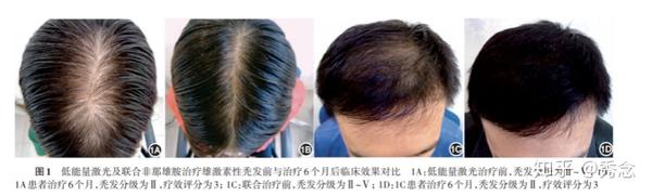 红斑狼疮能不能补硒（系统性红斑狼疮可以补硒吗）-硒宝网