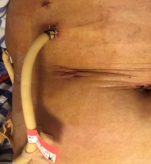 微创手术补硒有用吗(做手术后能吃硒片吗)-硒宝网