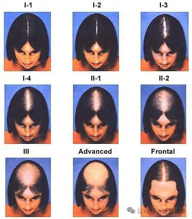 掉头发补硒有作用吗(脱发补硒)-硒宝网
