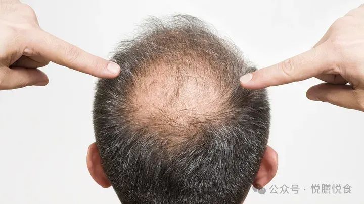 掉头发补硒有作用吗(脱发补硒)-硒宝网