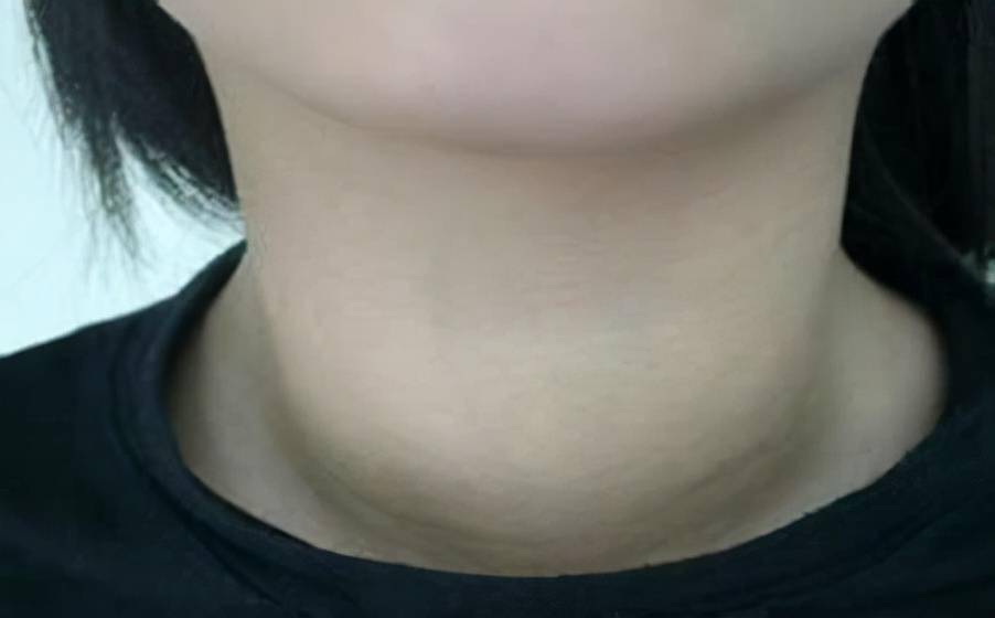 甲亢和甲减能补硒吗(能补甲亢硒甲减吗)-硒宝网