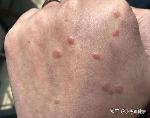 补硒能去掉扁平疣吗（去掉能补扁平疣硒吗）-硒宝网