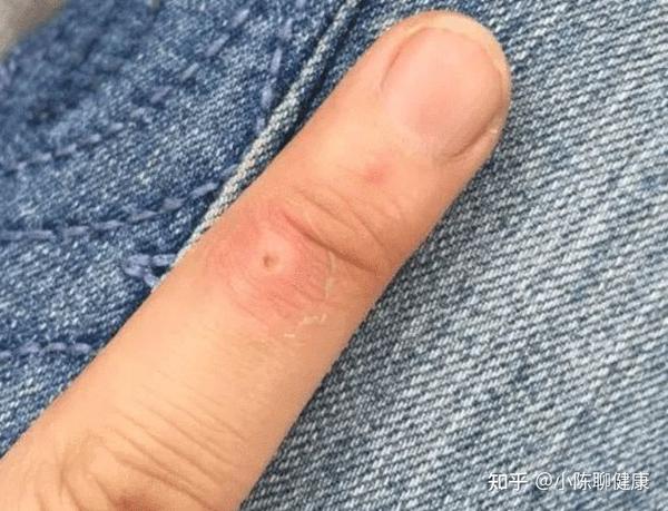 补硒能去掉扁平疣吗（去掉能补扁平疣硒吗）-硒宝网