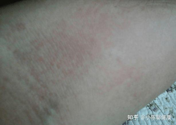 补硒能去掉扁平疣吗（去掉能补扁平疣硒吗）-硒宝网