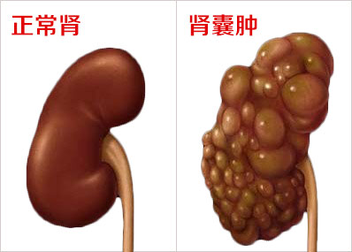 补硒对肾囊肿的作用(补硒)-硒宝网