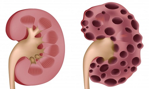 补硒对肾囊肿的作用(补硒)-硒宝网