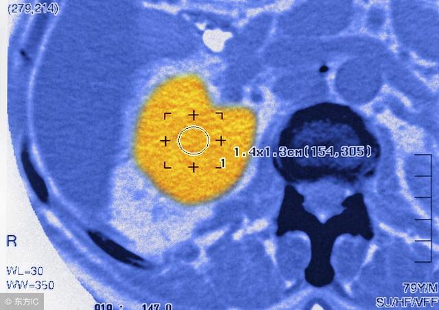 补硒对肾囊肿的作用（补硒有什么作用）-硒宝网