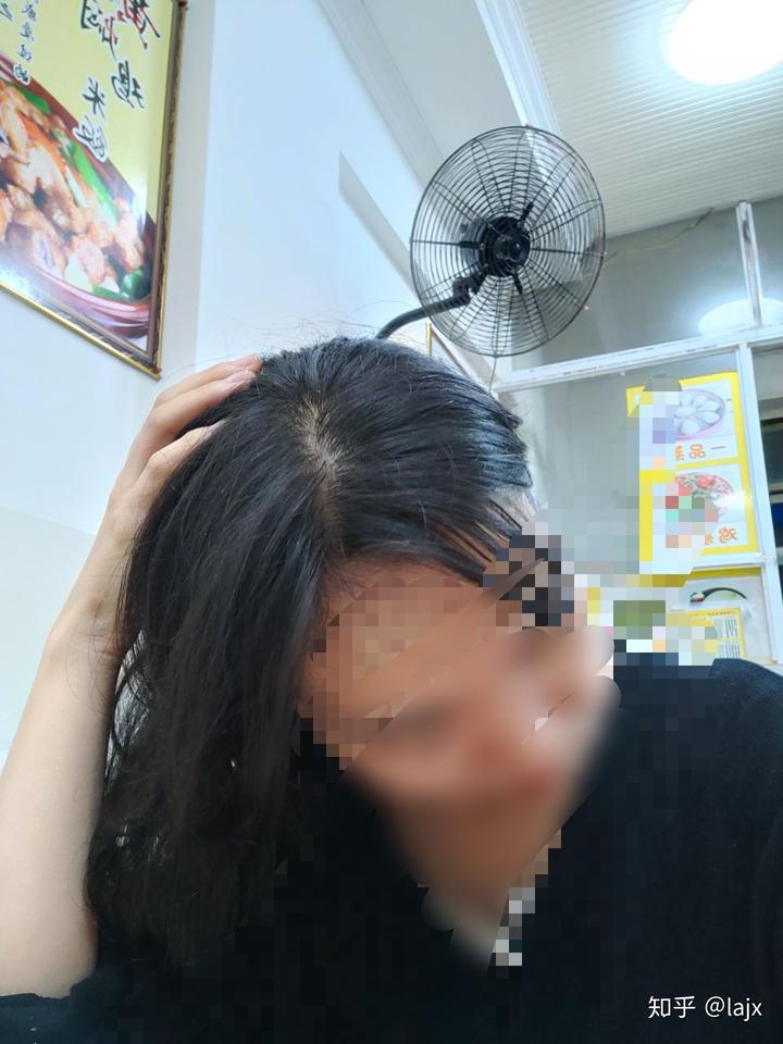 掉头发要补硒吗女生（补硒脱发是什么原因引起的）-硒宝网