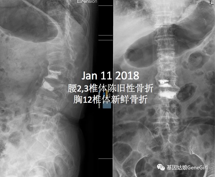 骨折 补钙(骨折补钙吃什么钙片好)-硒宝网