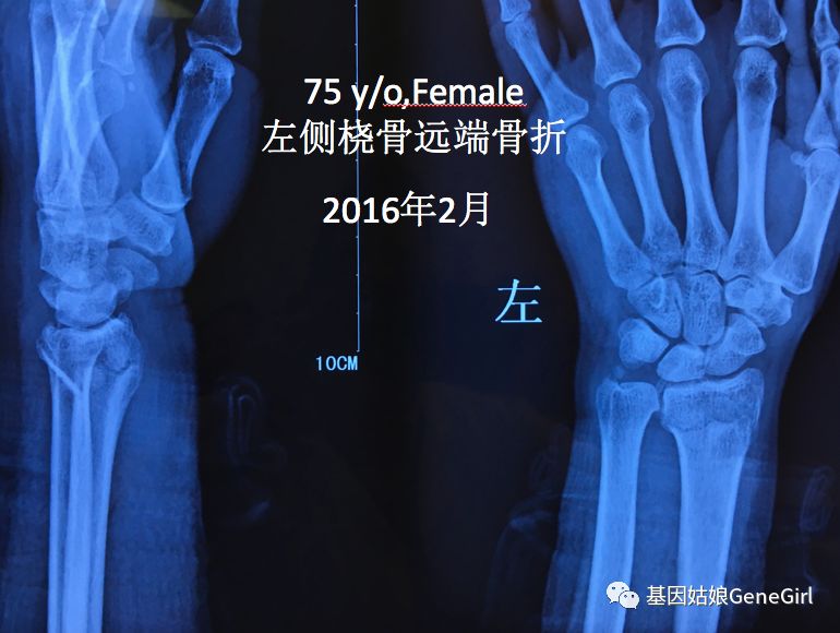 骨折 补钙(骨折补钙吃什么钙片好)-硒宝网