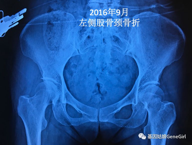 骨折 补钙(骨折补钙吃什么钙片好)-硒宝网