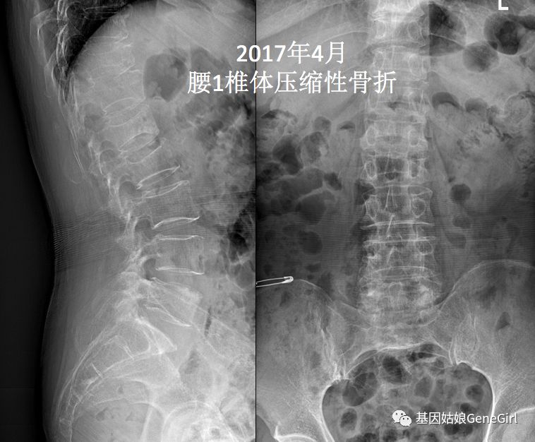 骨折 补钙(骨折补钙吃什么钙片好)-硒宝网