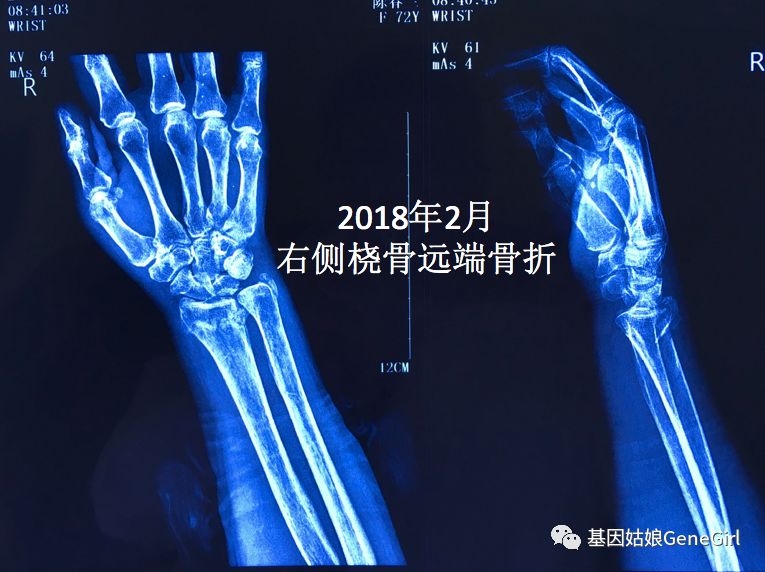 骨折 补钙(骨折补钙吃什么钙片好)-硒宝网